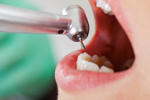 Best Emergency Root Canal Treatment in St James, MO